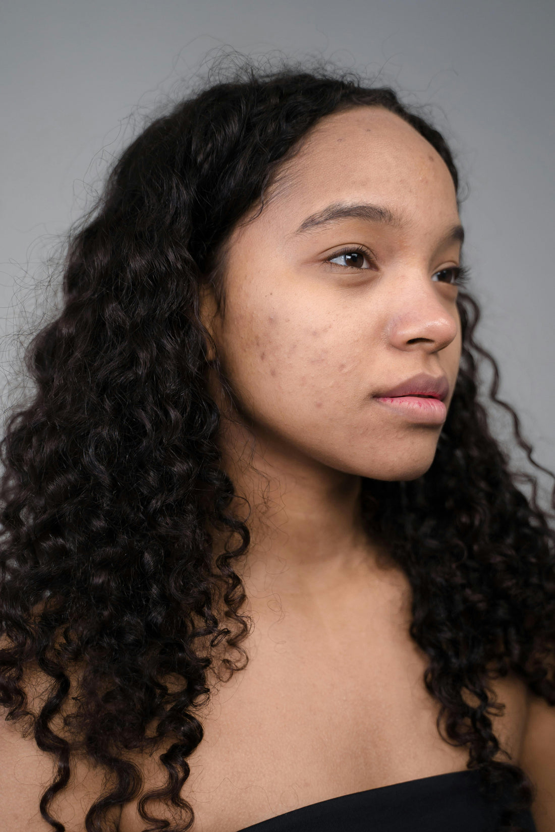  a women showing one side of her face with acne scars 